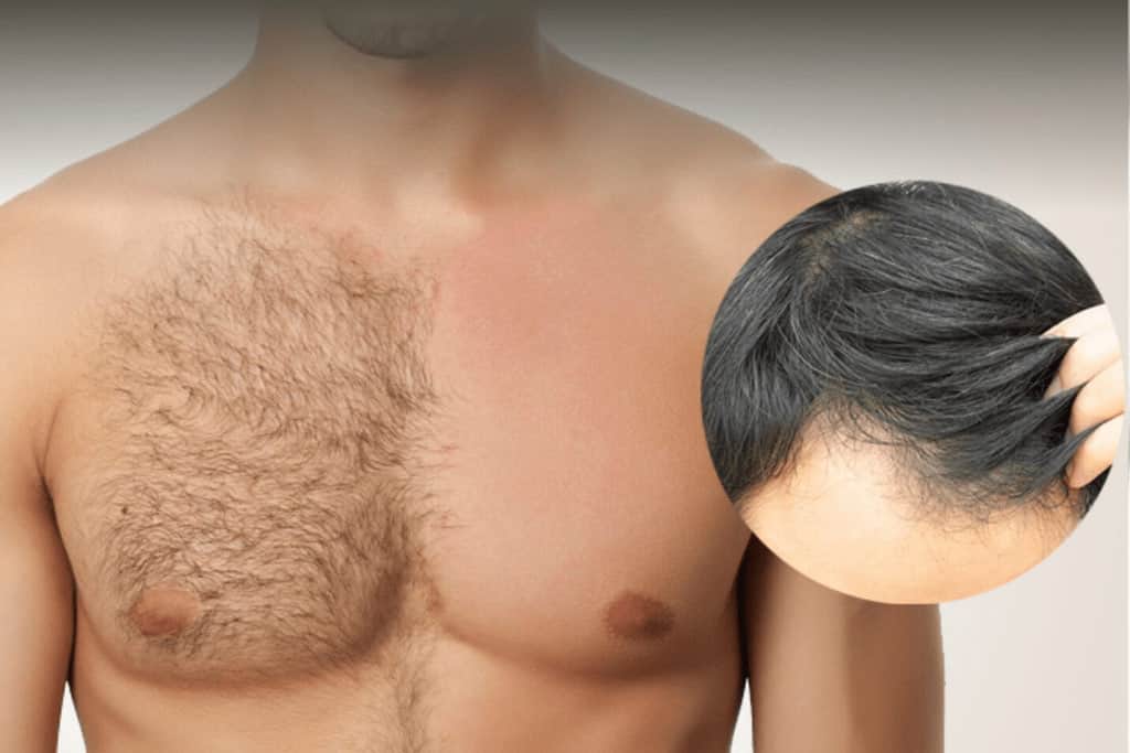Best Body Hair Transplant, Body Hair Transplant Cost in Gurgaon Best Body Hair Transplant, Body Hair Transplant Cost in Gurgaon