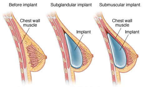 breast augmentation implant in gurgaon
