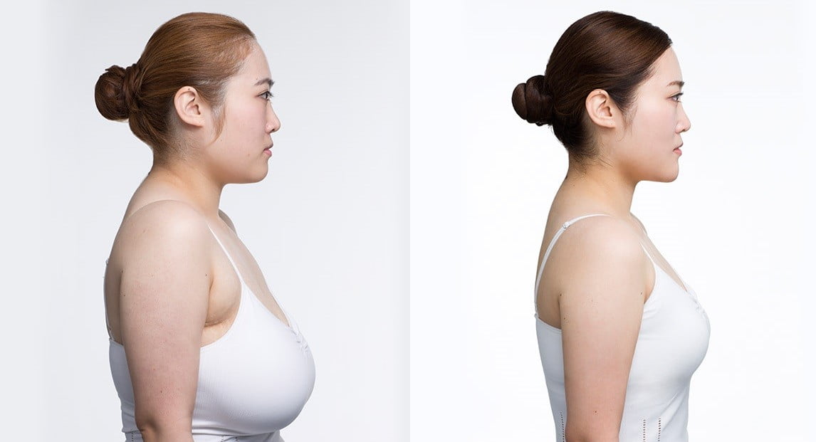 Female Breast Reduction Surgery, Breast Reduction Cost in Gurgaon