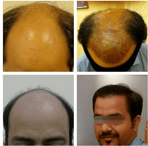 Are you a good candidate for hair transplant surgery  Dr Bonaros