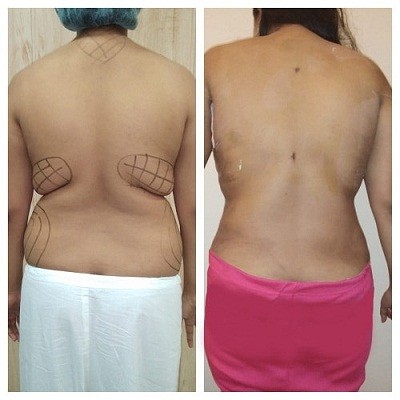 Liposuction Surgery in Gurgaon