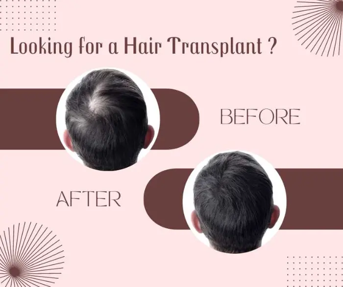 Looking for a Hair Transplant. Do not know, where to go, who is the right Doctor?? – Dr Ashish khare
