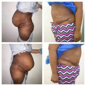 abdominoplasty