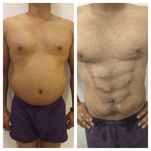 Six Pack Abs Surgery, Abs Creation Surgeon in Gurgaon