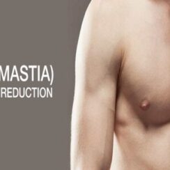 What is Gynecomastia?
