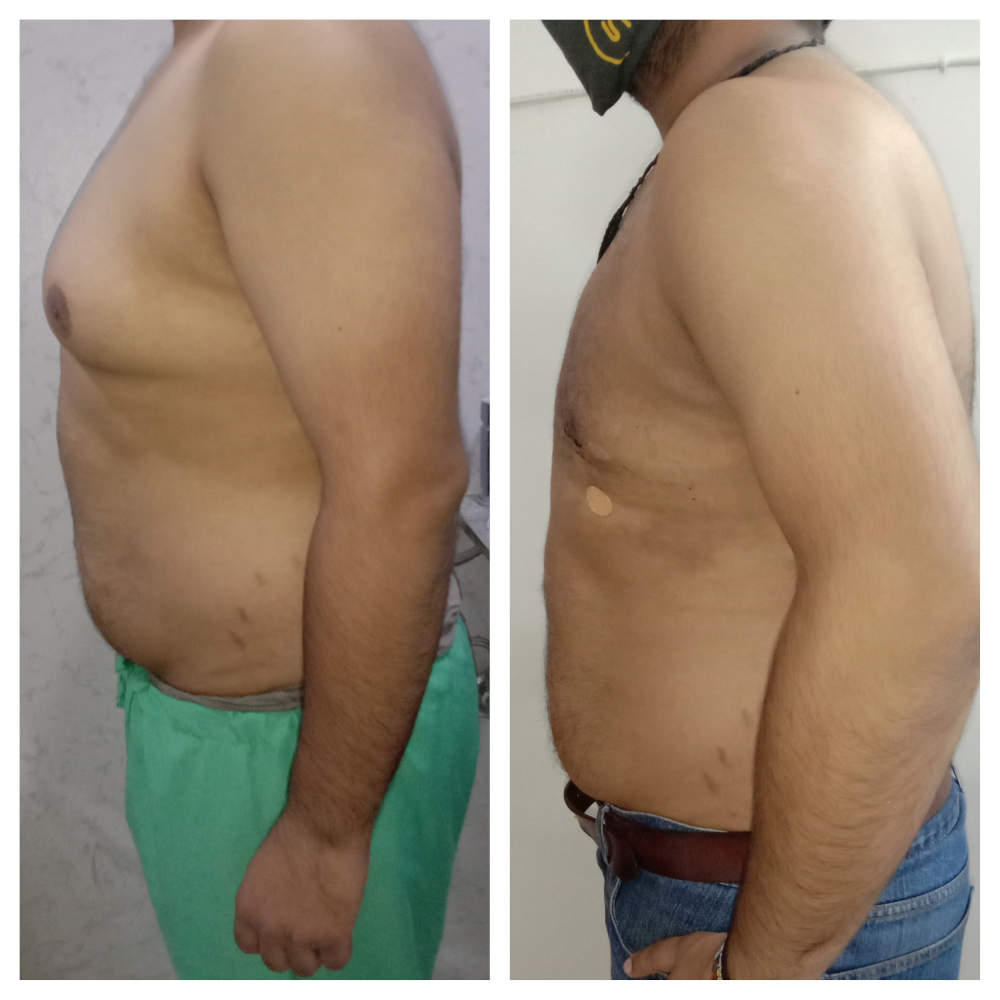 gynecomastia surgery in delhi