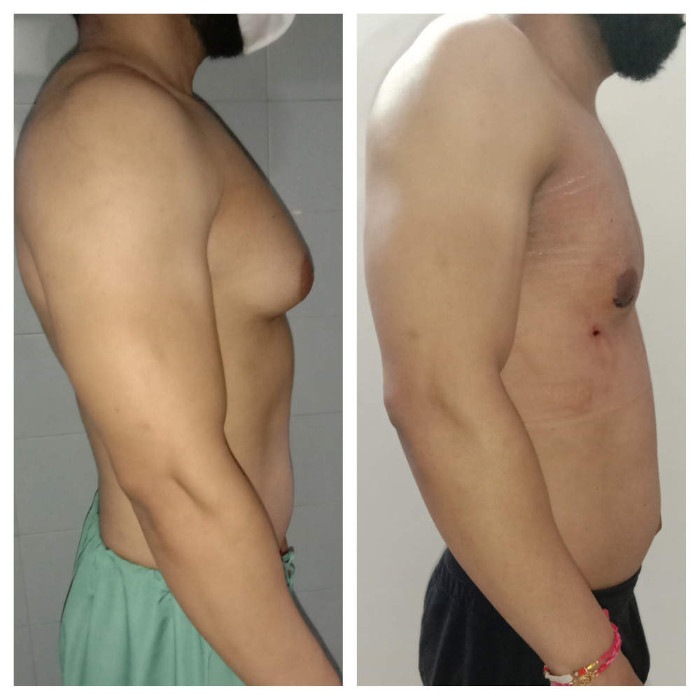 gynecomastia surgery in delhi