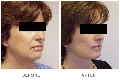 Non Surgical Facelift in Gurgaon