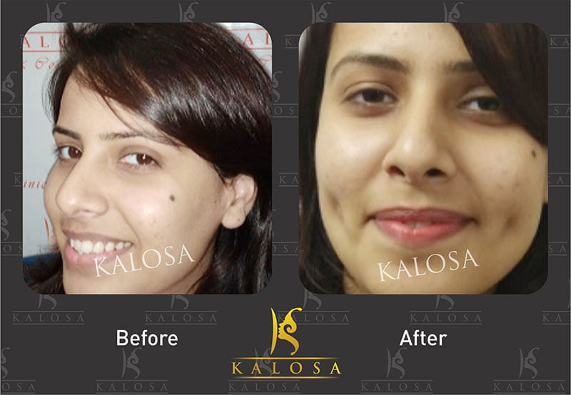 Kalo cosmetic surgery
