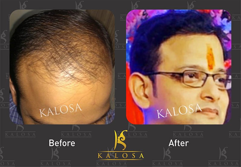 hair transplant in delhi