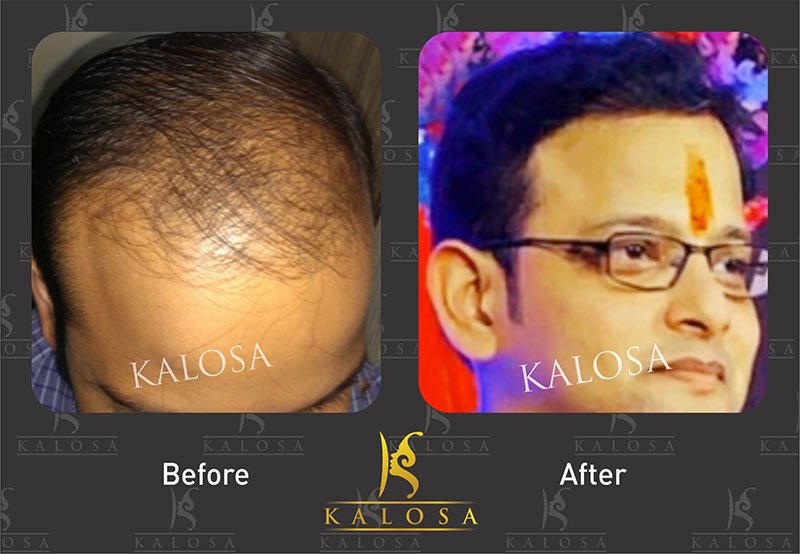 Best Hair Transplant In Delhi  Derma Miracle Clinic Delhi