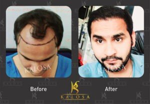 hair transplant in kanpur