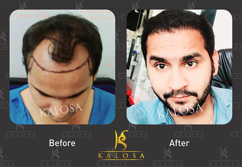hair transplant in kanpur