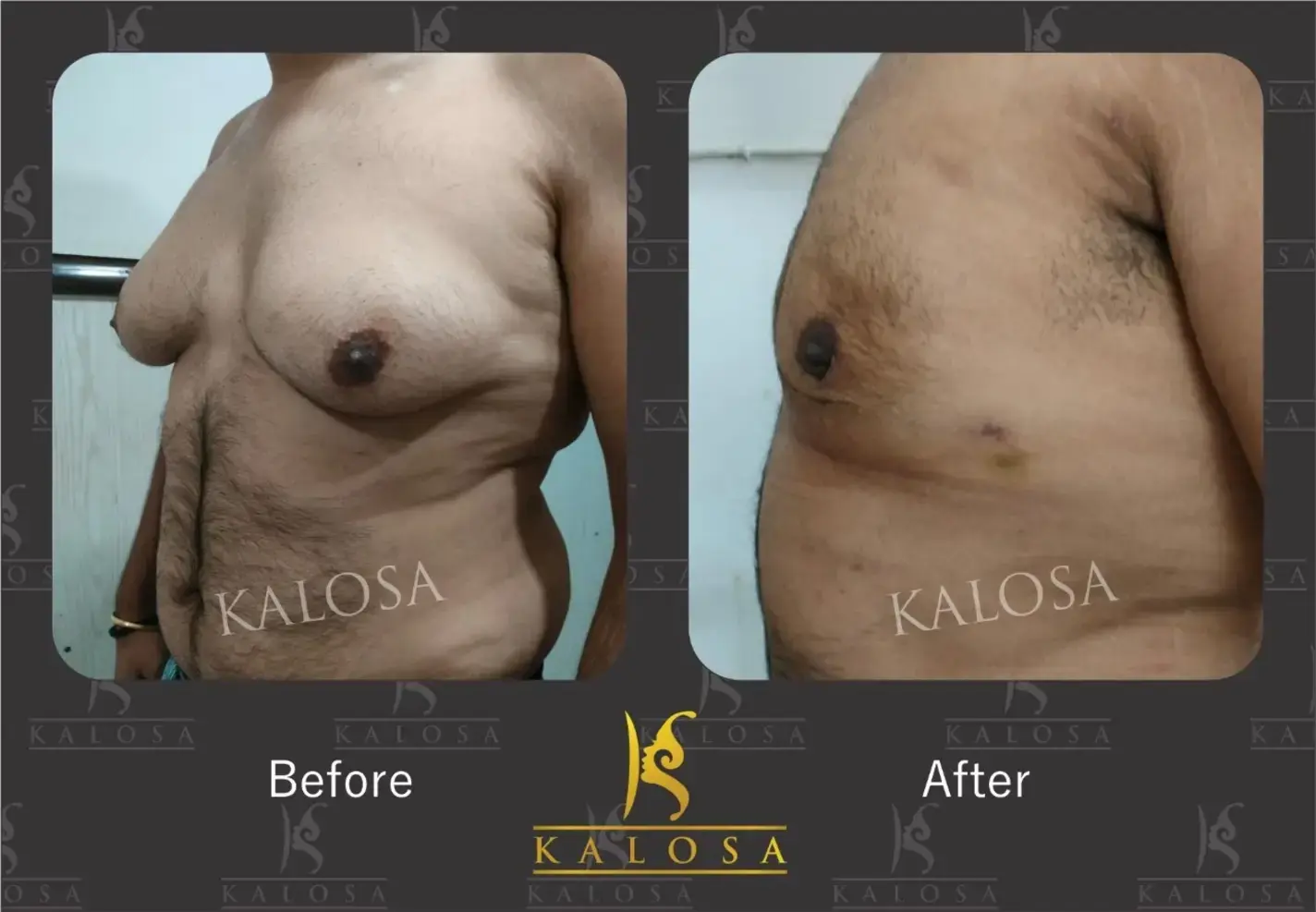 Gynecomastia