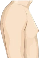 Illustration of Grade 1 gynecomastia, side view of the male chest
