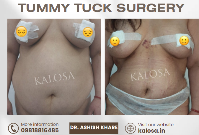 Grade 1 Gynecomastia