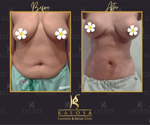 Vaser Liposuction
