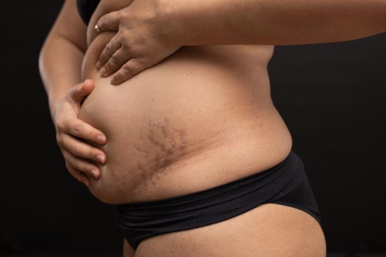 liposuction surgery (9)