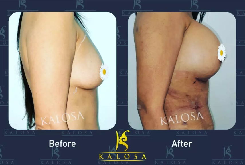 Breast Reduction