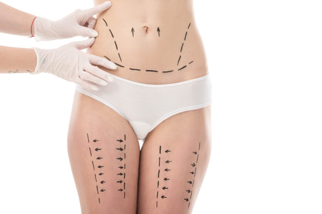 Liposuction Procedure: Recovery and Results