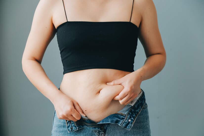 Cost of Liposuction or Belly Fat Removal Surgery in Gurgaon Delhi NCR