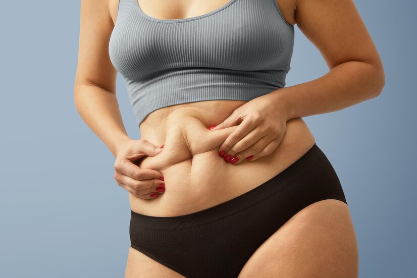 Explore Liposuction or Belly Fat Removal Surgery Cost in Delhi