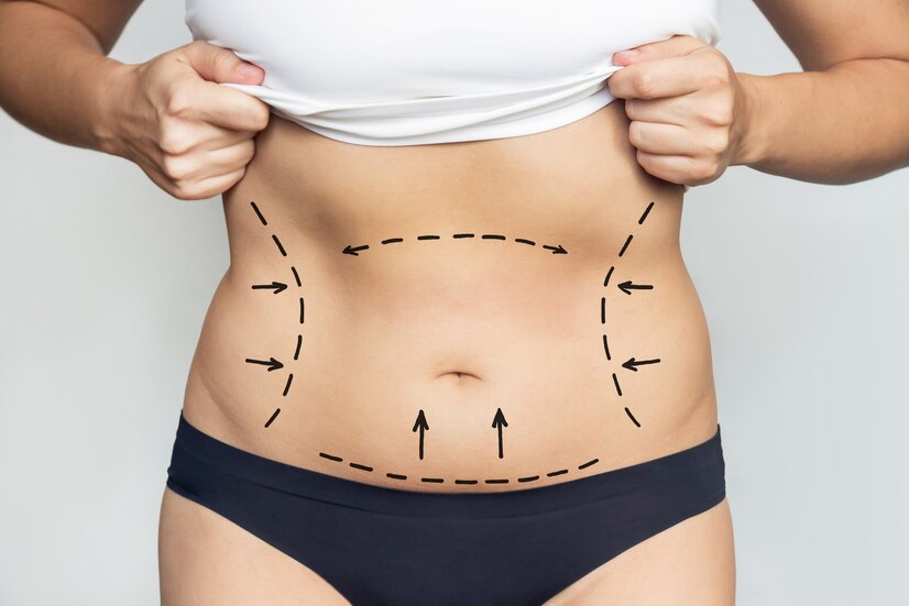 What is Lipo 360? The Ultimate Guide to 360 Liposuction | Gurgaon Delhi NCR