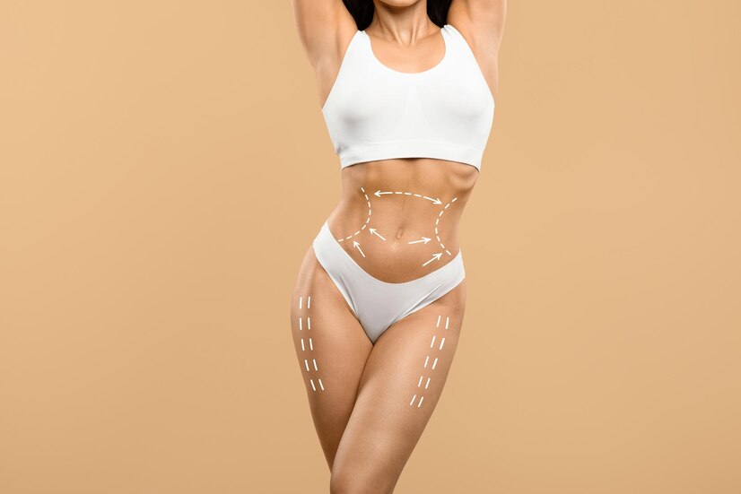 Laser Liposuction in Gurgaon Delhi NCR , Fat Removal Treatment