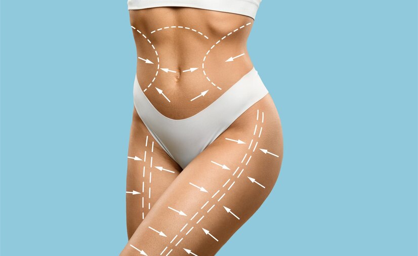 Thigh Liposuction Surgery in Gurgaon – Procedure, Cost & Benefits