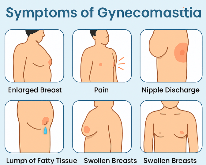 gynecomastia grade 3