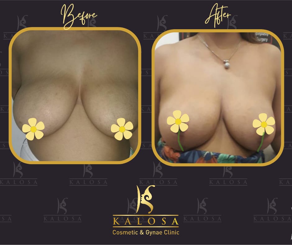 Breast Reduction