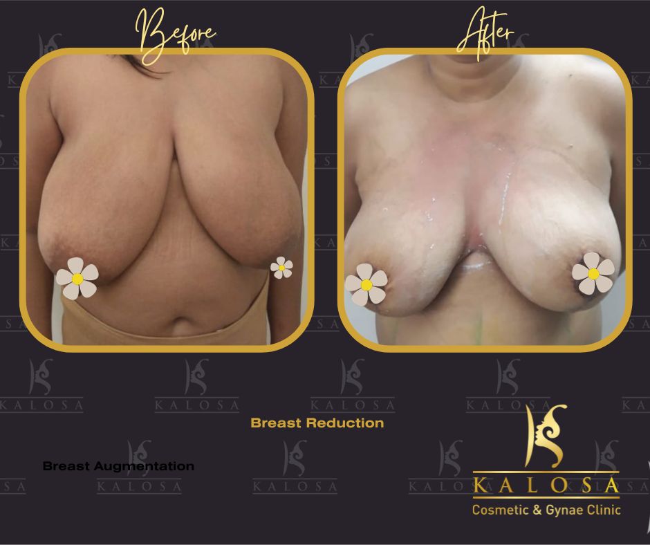 Breast Reduction