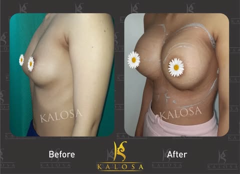 Breast implant