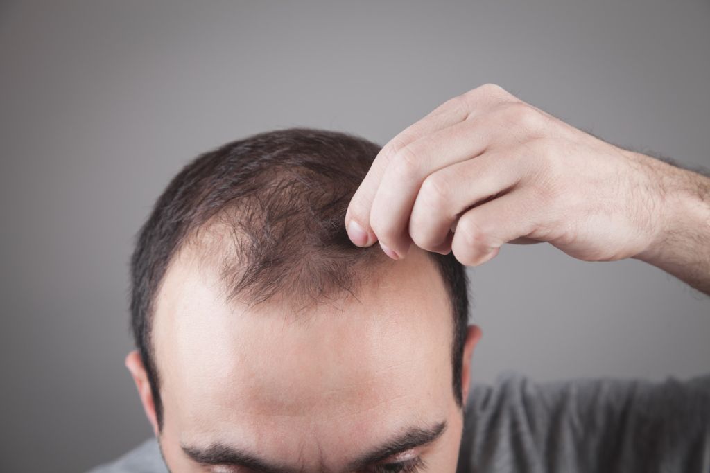 Hair Transplant in Gurgaon