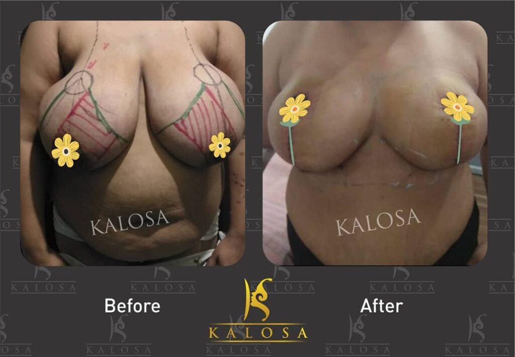 Breast reduction surgery also called as reduction mammoplasty , is a medical procedure that reduce the overall size of the breast
