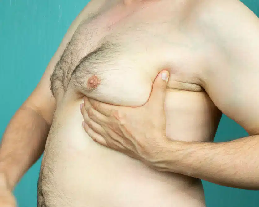Gynecomastia Surgery