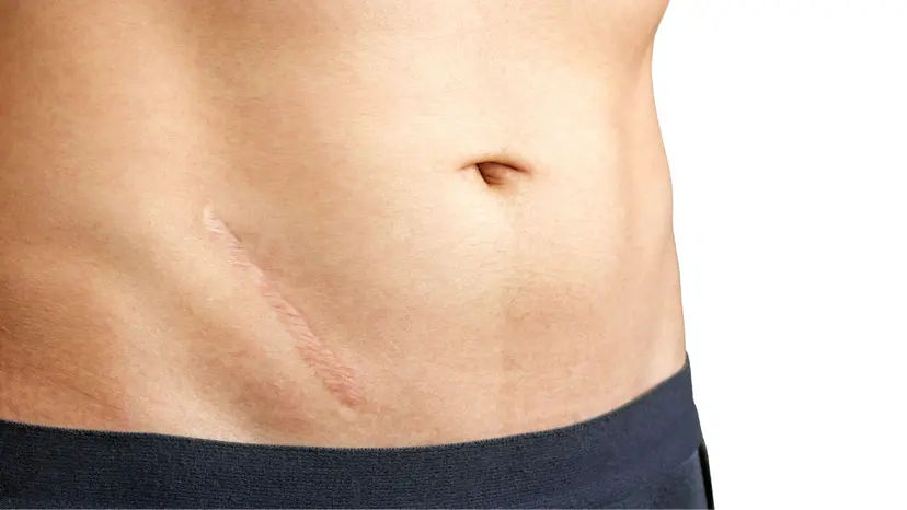 Scar Treatments in Gurgaon