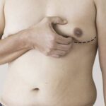 Liposuction Before and After: How Long Until You See Results?
