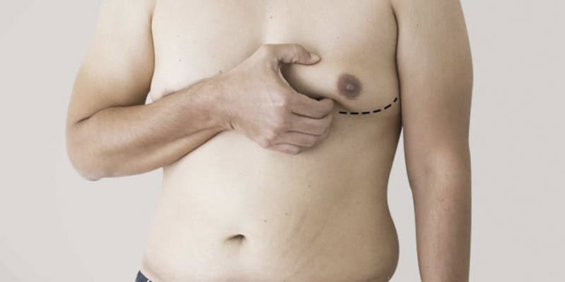 Gynecomastia