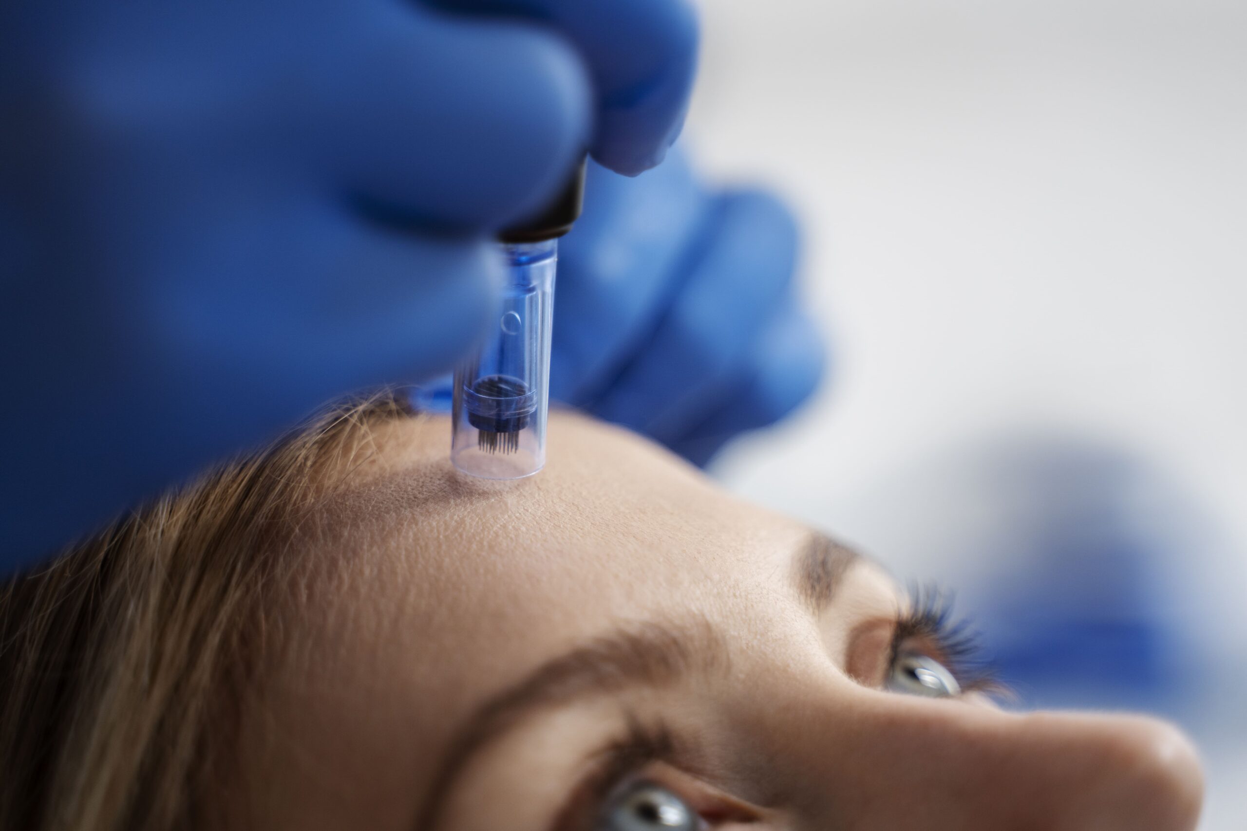 Microneedling cost in India : Treatment, Results, Benefits & Side Effects
