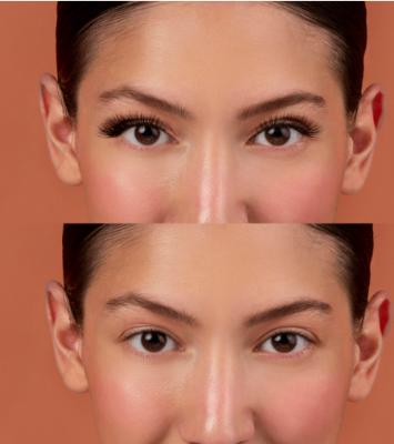 Image -2 natural looking Lip Reduction surgery Results in delhi by dr ashish khare