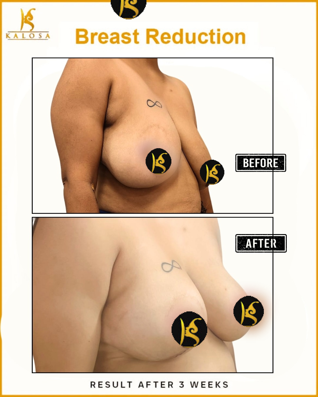 Breast Reduction