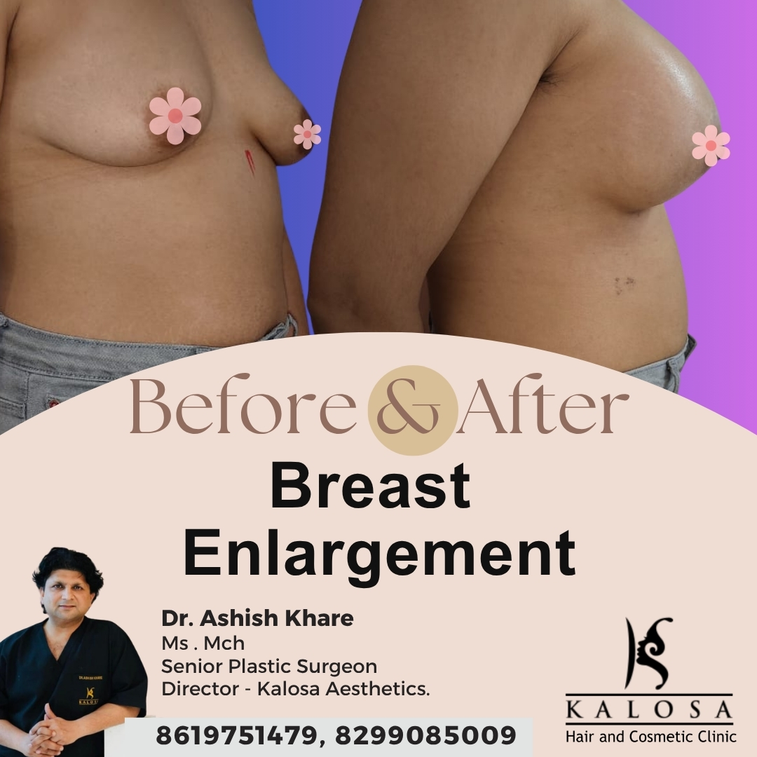 Breast Enlargement