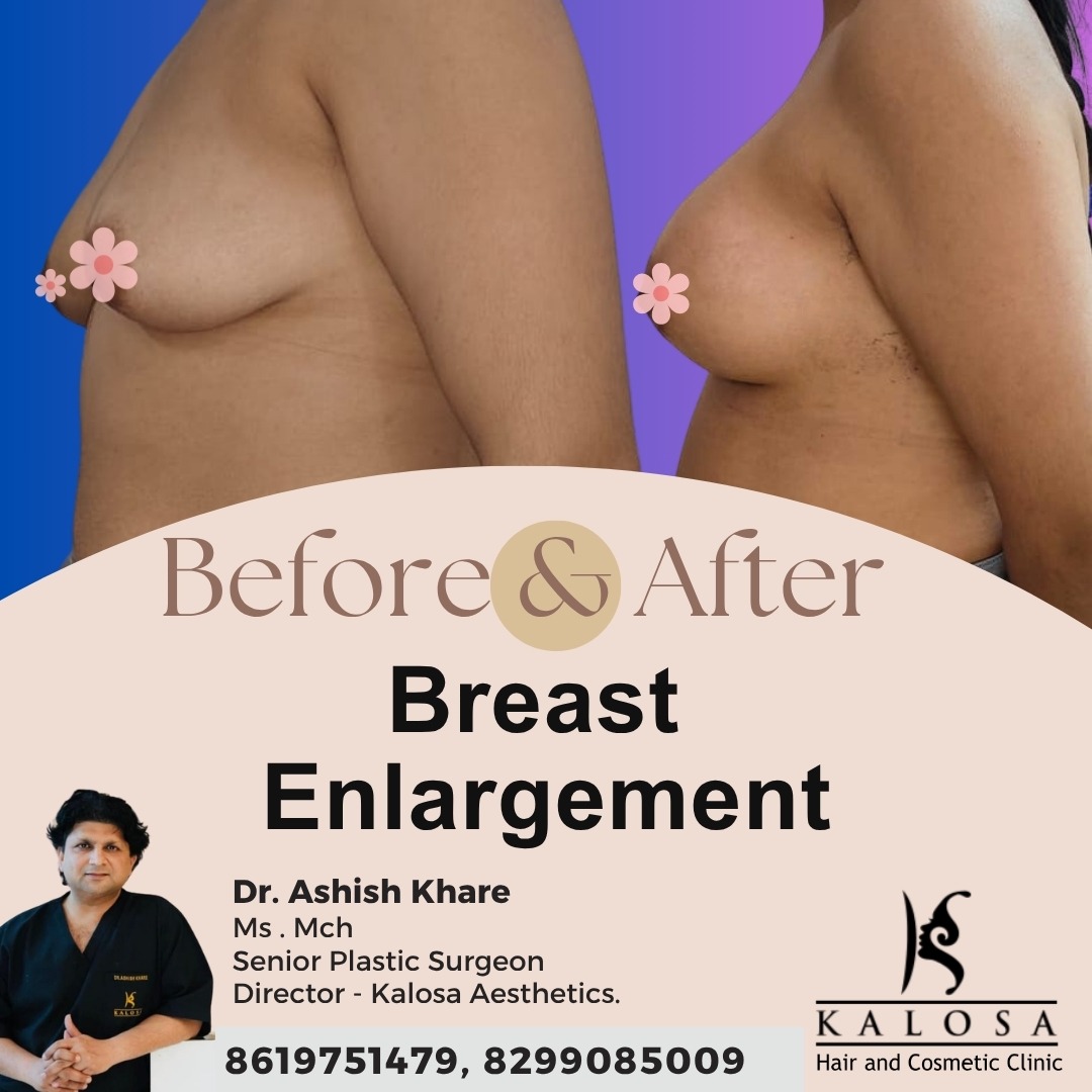 Breast Enlargement