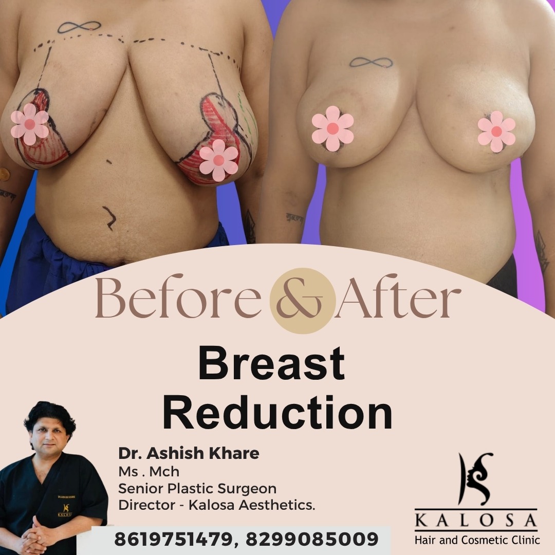 Breast Reduction Surgery
