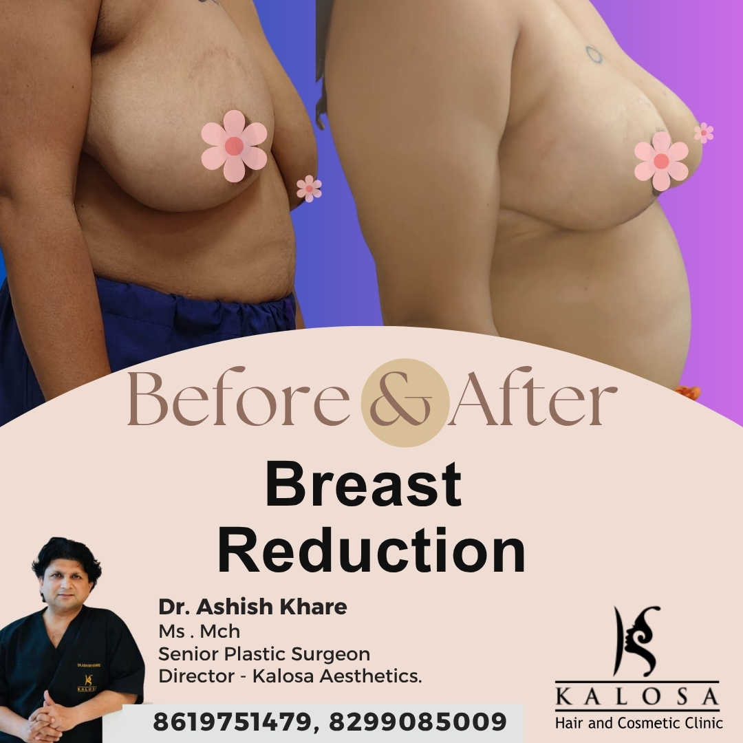 Breast Reduction Surgery