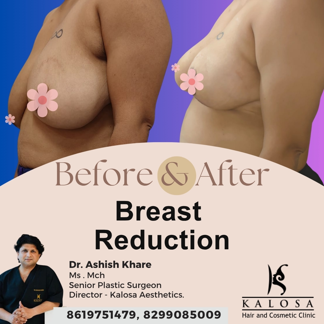 Breast Reduction Surgery
