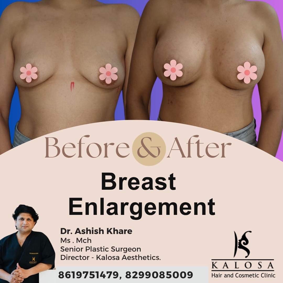 Breast Enlargement