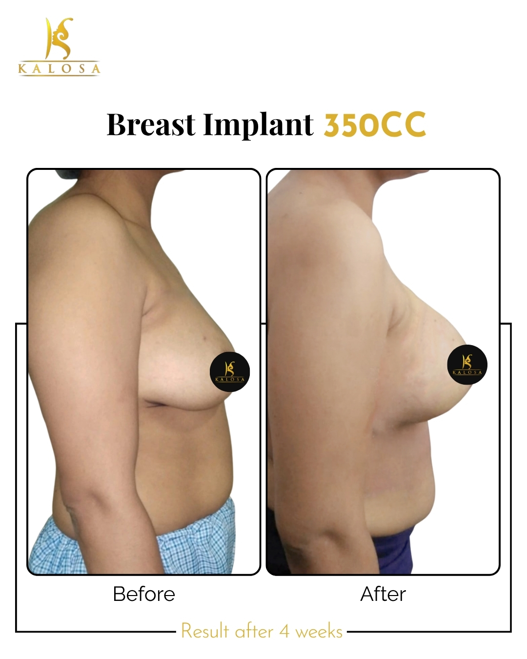 Breast Implant