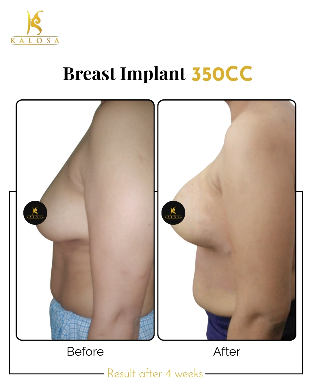 Breast Implant